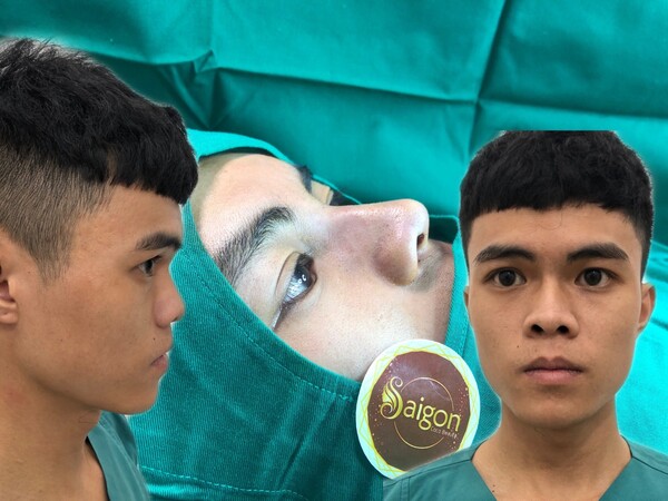 Nâng mũi nam
