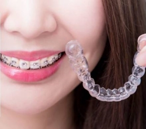 Niềng Răng Thẩm Mỹ