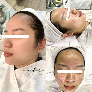 Liệu Trình Điều Trị Mụn