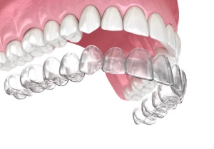 Niềng Răng Invisalign