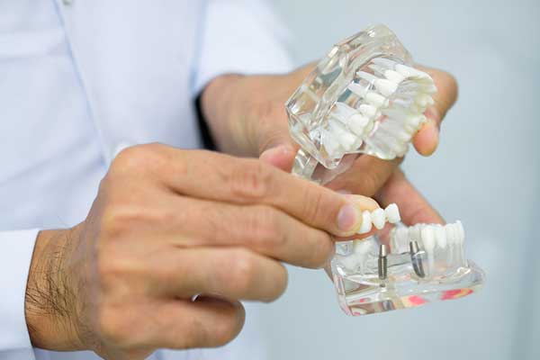 Cấy ghép Implant