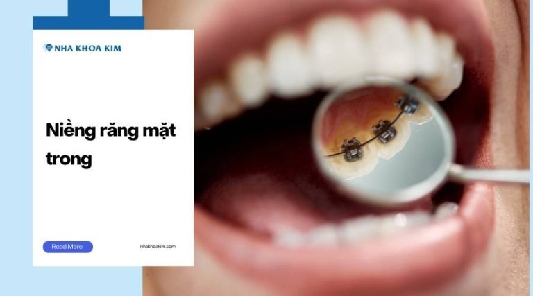 Niềng răng mặt trong