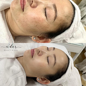 Liệu Trình Chăm Sóc Da PERFECTION