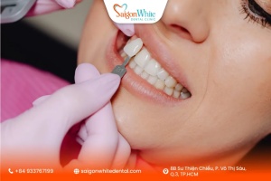Veneer Thẩm Mỹ