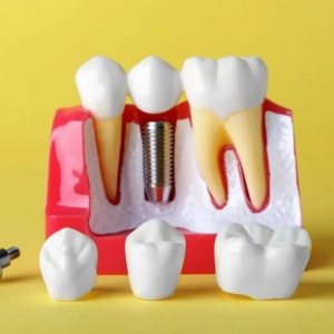 Trồng Răng Implant