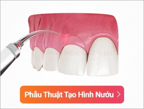 Phẫu thuật tạo hình nướu