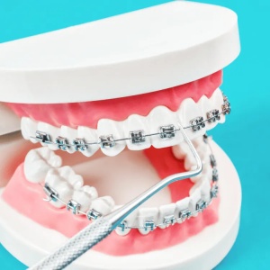 Niềng Răng Mắc Cài
